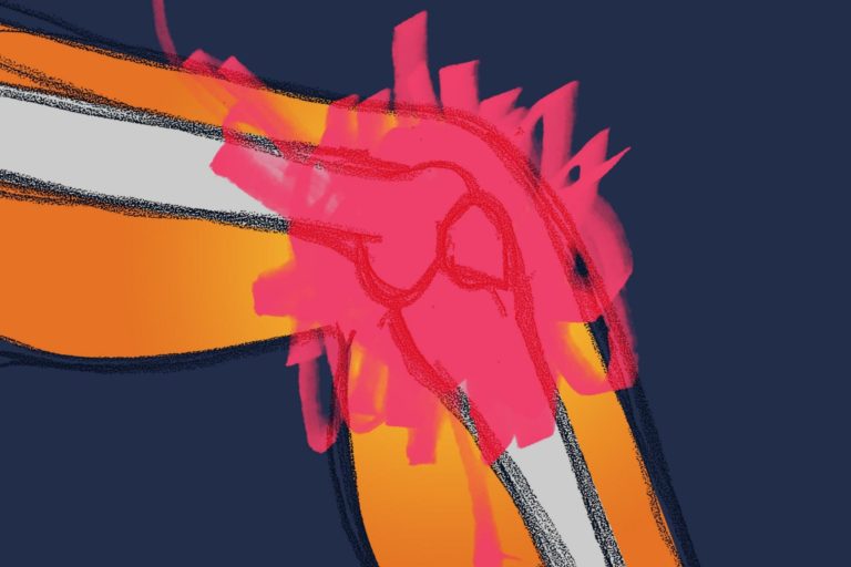 Новое понимание причин ревматоидного артрита