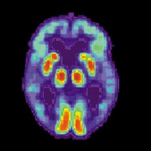 C:\Users\1\Desktop\PET-сканирование эмоцианальных зон мозга при болезни Альцгеймера демонстрирует угасание активности в височных долях..jpg