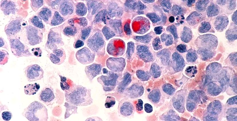 Изображение клеток человека с острым миелоидным лейкозом