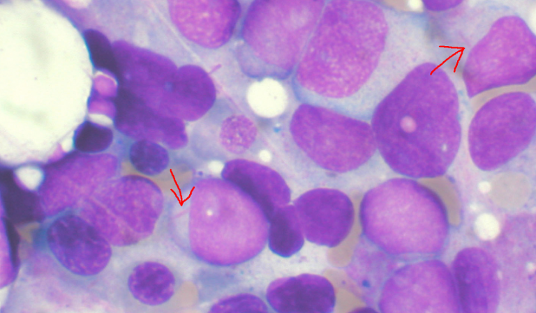 Лечение лейкемии