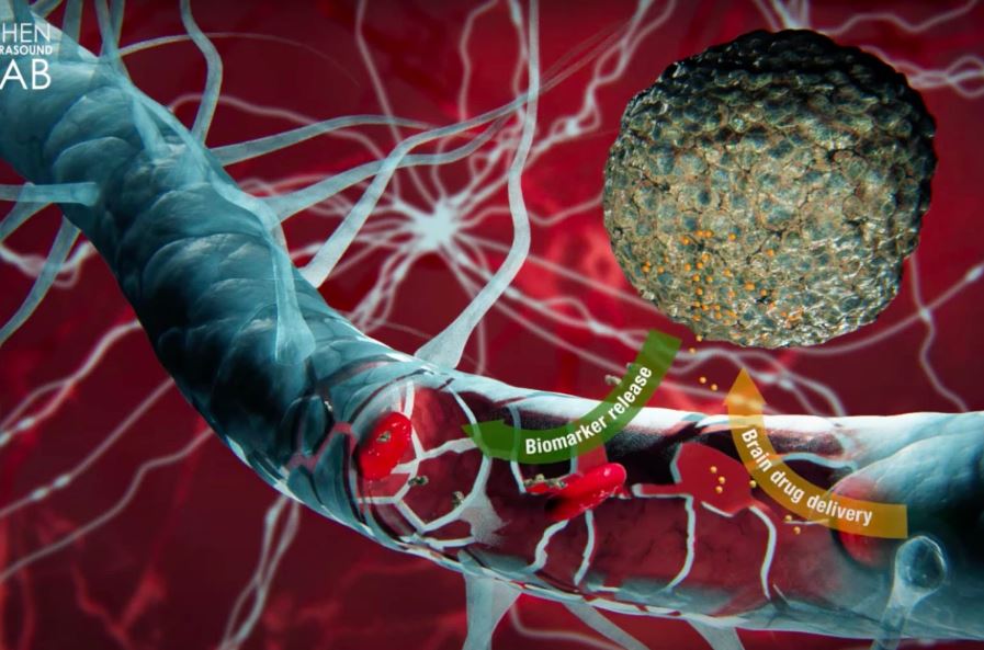 Ультразвук и анализ крови могут заменить инвазивную биопсию рака мозга
