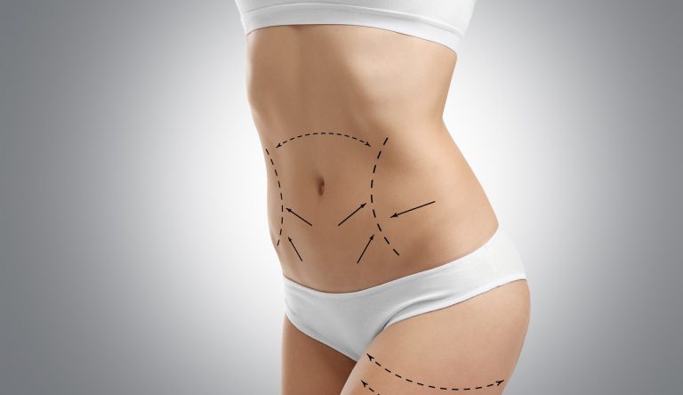 Подтяжка живота (абдоминопластика) в Турции