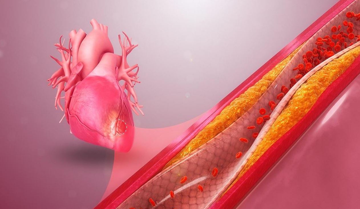Причины появления ишемической болезни сердца