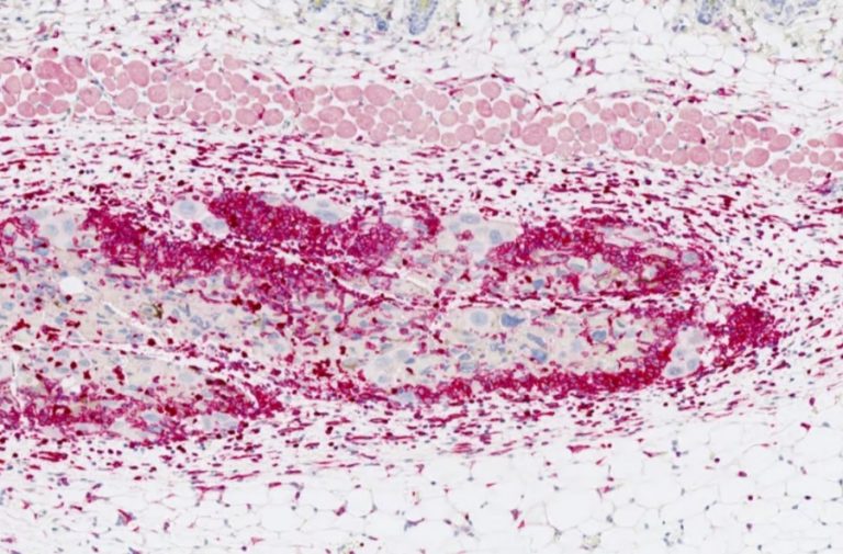 Вакцина от рака показала многообещающие результаты в тестах на мышах