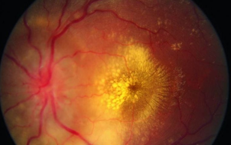 Гипертоническая ретинопатия