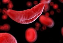 лечение людей с серповидно-клеточной анемией